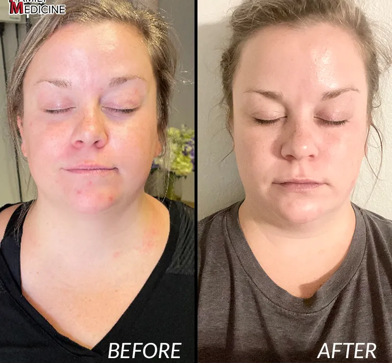 Before and after photos of a Lubbock Family Medicine patient following a VI Peel